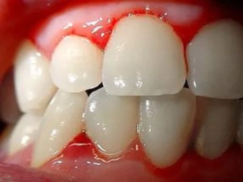 ostriy periodontit