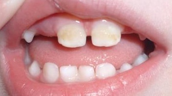 Kariyes molochnih zubov