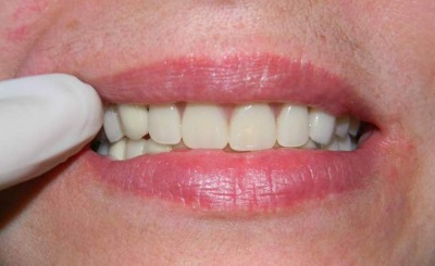 Zubniye protezi