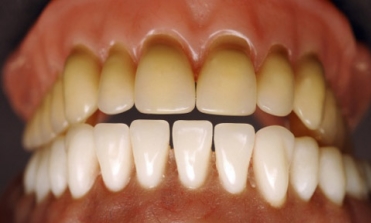 Jeltizna zubov