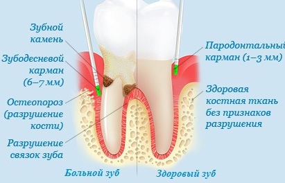 Zdoroviy i bolnoy zub