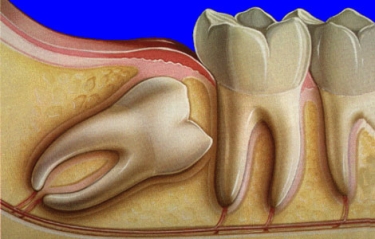 retinirovanniy zub