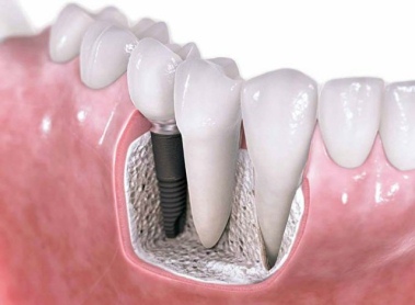 Implantaciya bokovih nijnih zubov