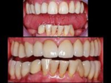 implantaciya nijnih jevatelnih zubov