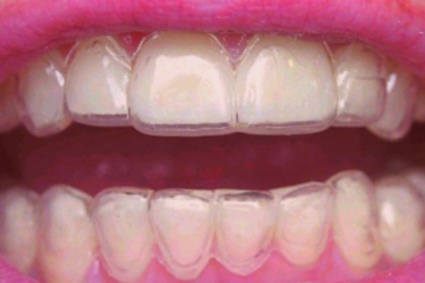 korrekciya zubov