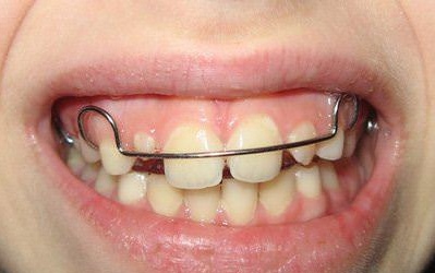  plastinki na zubah