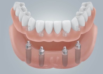 syemnaya konstrukciya na 4 implantah