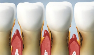 krayevoy periodontit