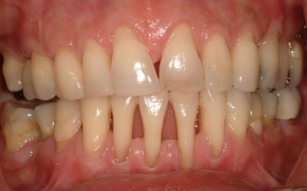 marginalniy periodontit