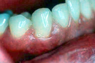 ostriy verhushechniy periodontit