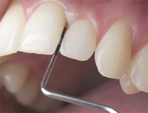 periodontit kraevoy lecheniye