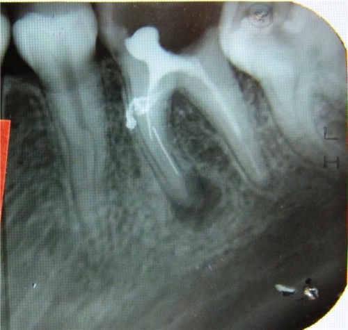 granulema zuba na snimke