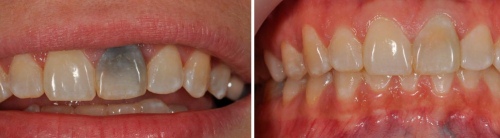 vnutrennee otbelivanie zuba do i posle