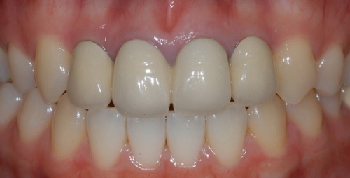 Почему чернеет десна возле импланта зуба