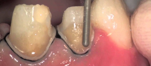 preperirovanie zuba