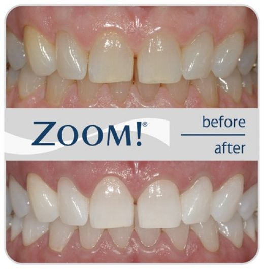 отбеливание зубов, метод, технология zoom 2